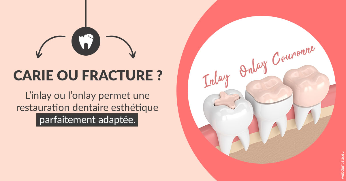 https://dr-didier-szwarc.chirurgiens-dentistes.fr/T2 2023 - Carie ou fracture 2