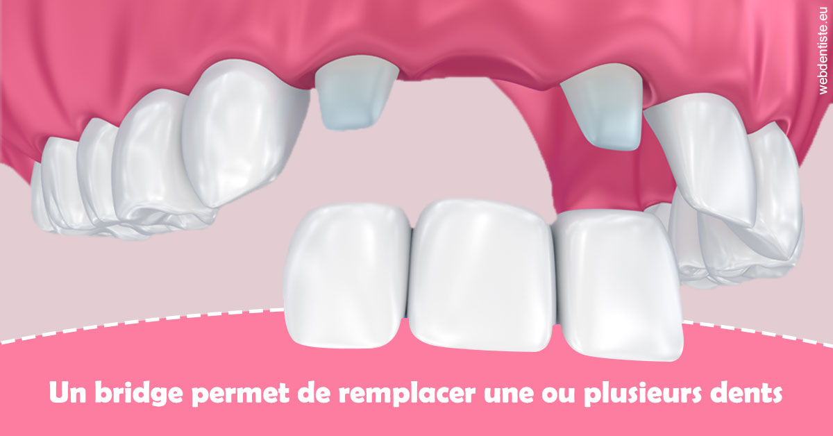 https://dr-didier-szwarc.chirurgiens-dentistes.fr/Bridge remplacer dents 2
