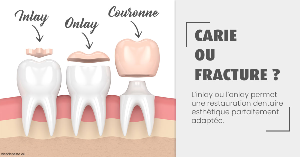 https://dr-didier-szwarc.chirurgiens-dentistes.fr/T2 2023 - Carie ou fracture 1