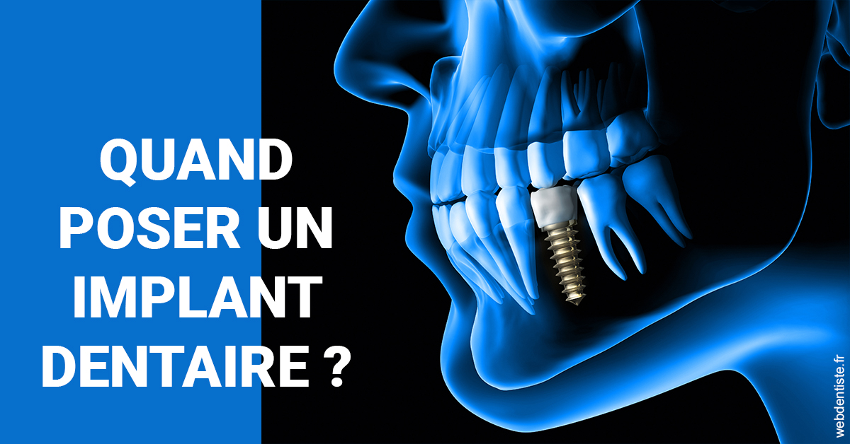 https://dr-didier-szwarc.chirurgiens-dentistes.fr/Les implants 1