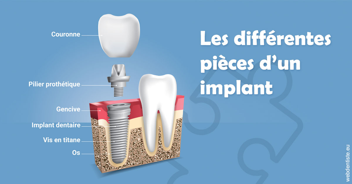 https://dr-didier-szwarc.chirurgiens-dentistes.fr/Les différentes pièces d’un implant 1